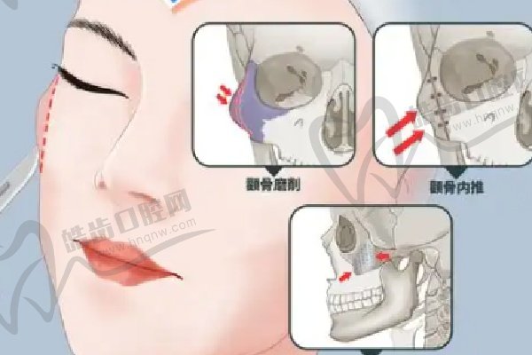 北京艺美不开刀降低颧骨后悔了？不后悔！王东脂肪降颧骨微调安心定制,36000元起改善凸颧骨