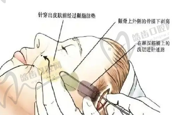 巩敏不开刀降低颧骨可以吗？可做2mm吸脂降颧弓/苹果肌下缘/下颌缘上缘就在北京艺美口碑好