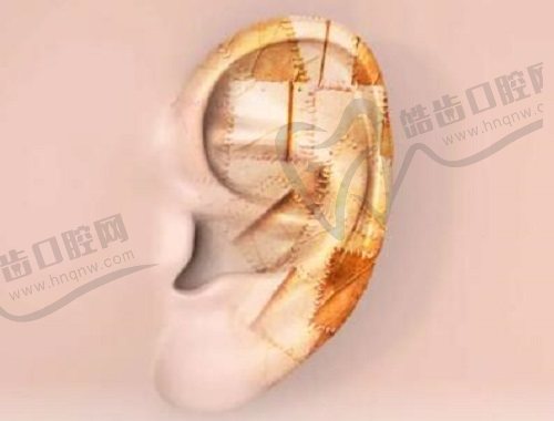 广州成人耳再造医院哪家好?广州高尚医疗美容排第一,余文林技术好费用4.5 - 7.5万