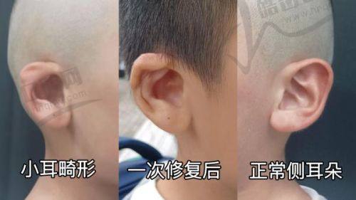 梁宗建双眼皮做得好吗？揭秘其手术效果自然且技术精湛的口碑密码