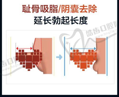 二、卿银医生筋膜提升术价格解析