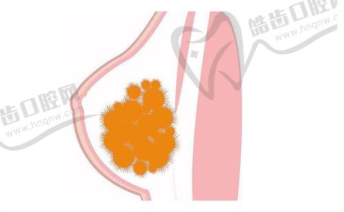三、吴雅娜内外轮廓注射优势技术盘点