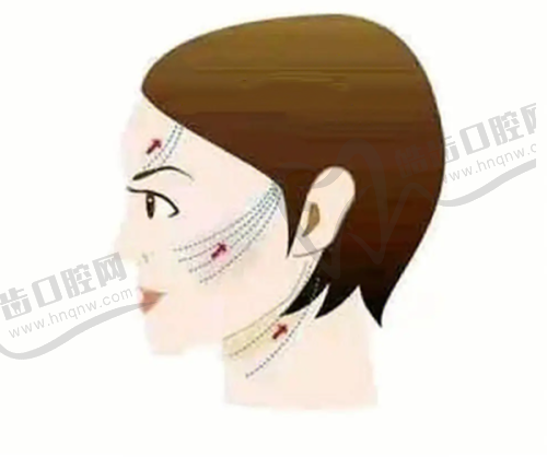 三、卿银医生筋膜提升术优势技术盘点