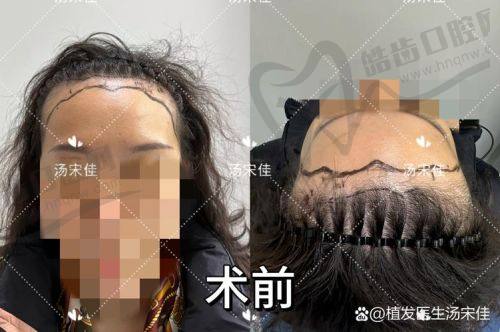 2025 植发预约不用慌！植发在哪里预约？碧莲盛、大麦微针等入口全攻略