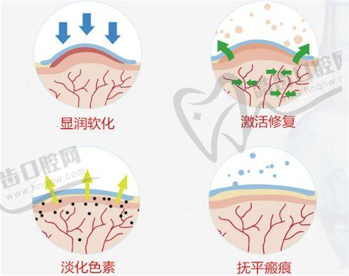 上海華美整形醫(yī)院艾莉薇風(fēng)尚版玻尿酸真人實(shí)例三