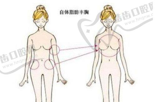 剖腹产疤痕修复费用及影响因素