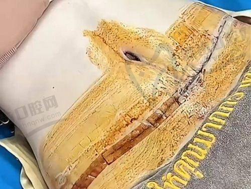 广州曙光医院东国水光针1000元起，深层补水提亮肤色，告别暗沉细纹！