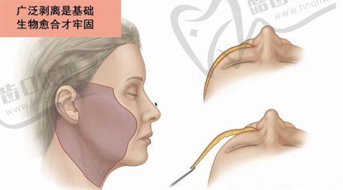 四、武汉天佑双眼皮怎么样？2025年手术方案与费用明细