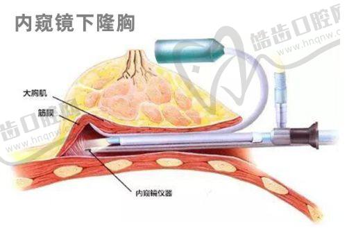 菲林普利隆鼻打1 - 2针的适用情况