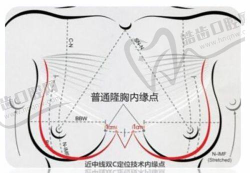 菲林普利隆鼻打1 - 2针与其他隆鼻方式的比较
