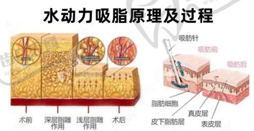 西安国际医学中心弗馒胶娇针项目真人实例
