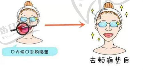 选择菲林普利隆鼻的注意事项