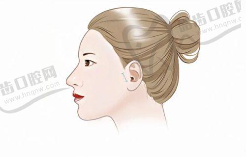 上海華美整形醫(yī)院與艾莉薇風(fēng)尚版玻尿酸相關(guān)其他類型的收費(fèi)價(jià)格參考