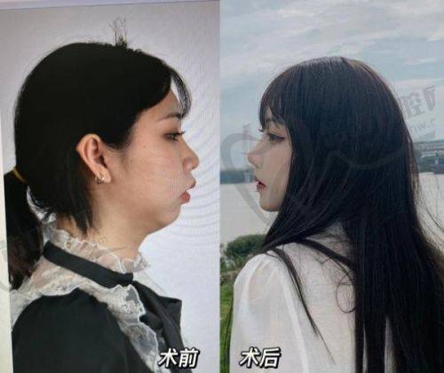 重庆松山何军双眼皮实例惊艳，价格也不贵只要4650元起——实例成效显著