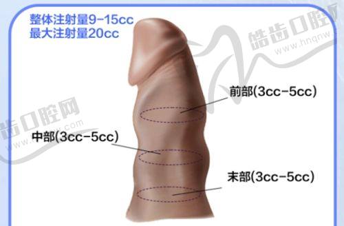 2. 石家庄眼窝凹陷填充术式与价格差异