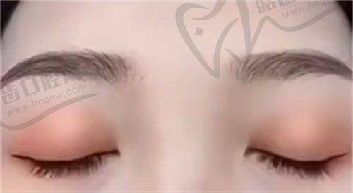 重庆松山医院双眼皮手术：苟磊医生技术不错显实力