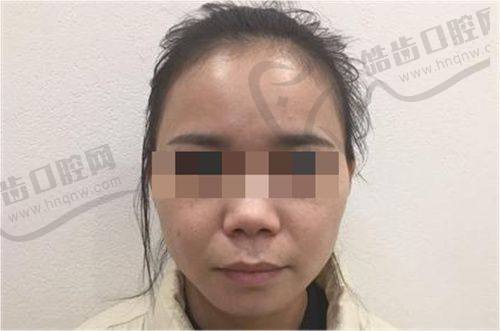 深圳富华整形孙占峰注射乔雅登玻尿酸，低至4618元，孙占峰手法娴熟打造自然美