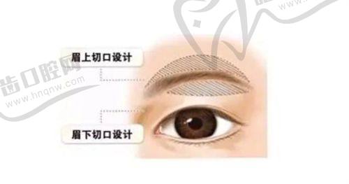 重庆松山医院双眼皮手术：真人实例见证满意成效