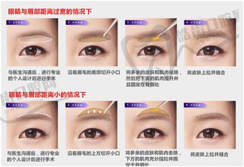 重慶松山醫(yī)院段艷軍隆鼻怎么樣?學(xué)術(shù)成就展風(fēng)采