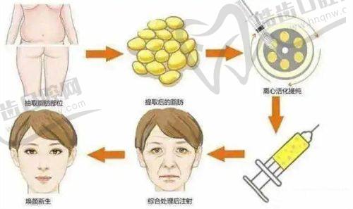 深圳富华整形孙占峰注射伊婉玻尿酸，低至1500元，孙占峰先进注射技术塑美