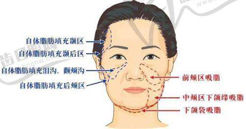 重庆松山医院双眼皮手术：优质服务保护手术体验