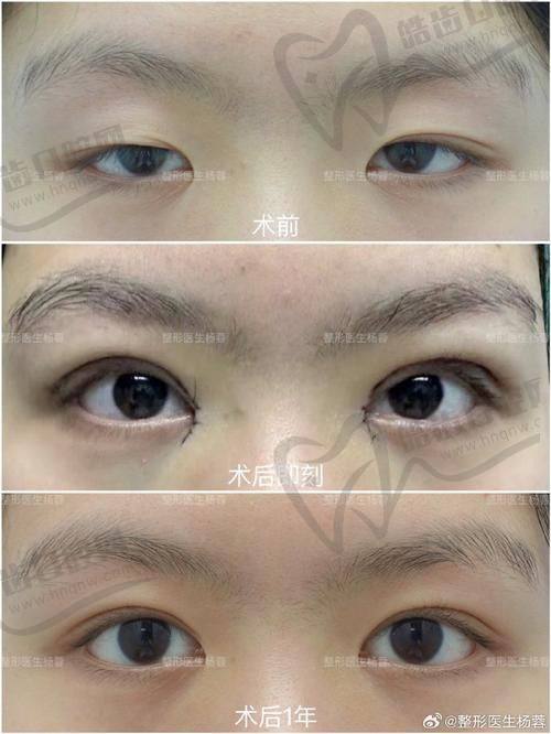 北京嘉禾李燕医生的真实实例见证