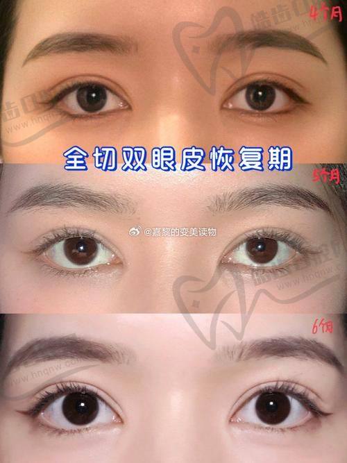 北京嘉禾李燕医生的手术操作技巧