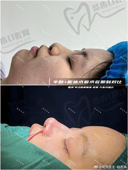 华 西李正勇鼻修复价格揭秘：中重度修复起步就要5万，动辄6万+