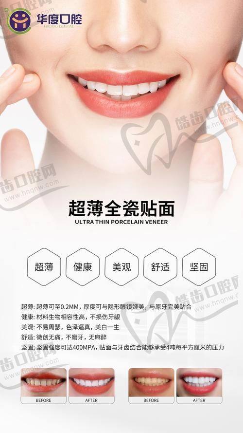 牙齿贴面的价格是多少钱一颗半口及全口修复