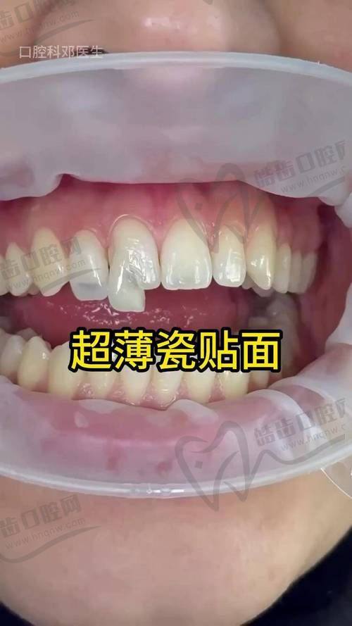 牙齿贴面的价格是多少钱一颗与技术特色的关系
