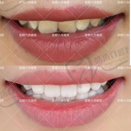 牙齿贴面的价格是多少钱一颗地区差异