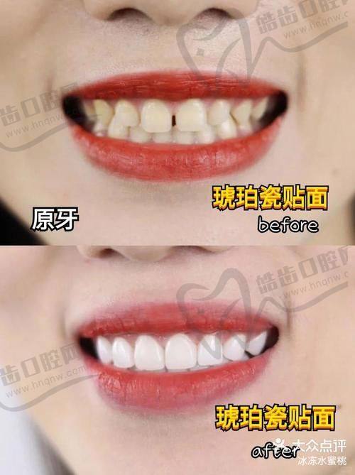 牙齿贴面的好处与坏处（结合视频全过程实例分析）