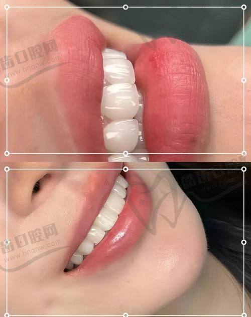 牙齿贴面视频全过程中的DSD微笑设计：美学与功能的双重保护
