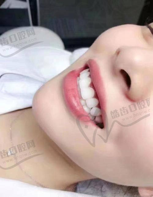 如何避免牙齿贴面伤害？——专精医生与材料选择指南