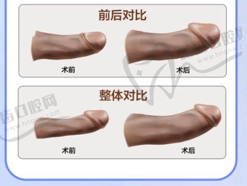 周晚香医生的毛发移植技术优势