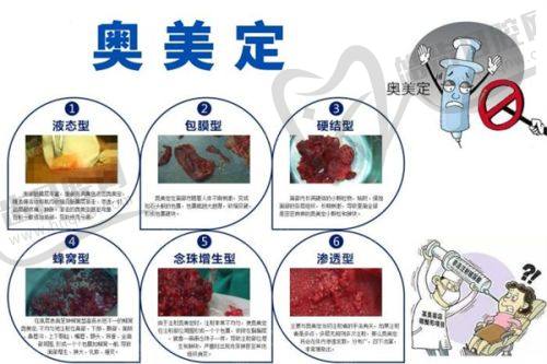 刘静坤医生毛发移植口碑评价及反馈内容