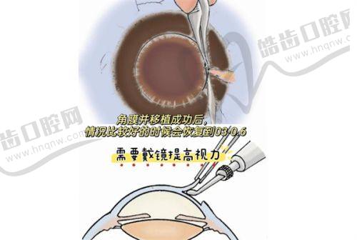三、爱尔眼科2025年特色诊疗项目价格