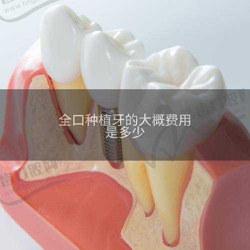 二、佛山满口种植牙单颗种植体费用：进口vs国产价差显著