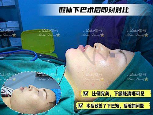 玻尿酸墊下巴會(huì)變形嗎？哪些情況容易導(dǎo)致移位擴(kuò)散
