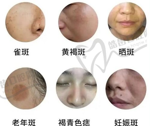 成都美容整形医院任华英医生去胎记，5平方厘米内800-1000多元，超5平方厘米每平120元 