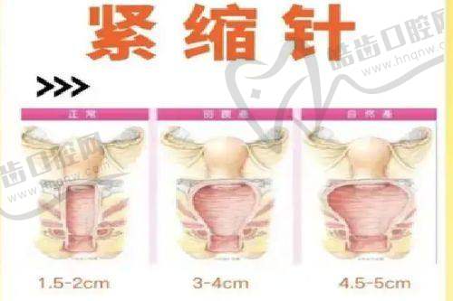硅胶假耳朵要多少钱？影响义耳价格的其他因素