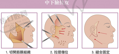 三、滕利医生在正颌手术方面有啥特长？