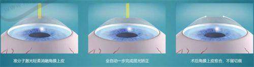 深圳友华普惠眼科半飞秒手术价格影响因素