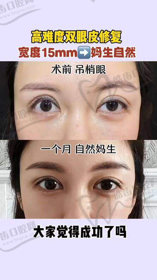 技术对比：宋桂霞 vs 滕双燕，谁的双眼皮修复更牛？