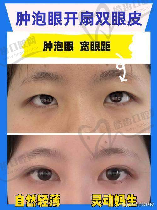 小编总结：谁更值得你放心托眼？看你的需求！