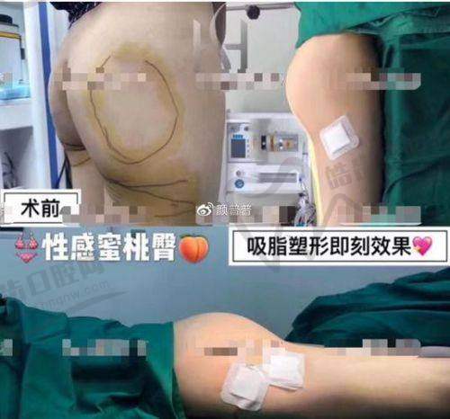 四、成都王欣吸脂靠谱吗？全流程扒个底朝天