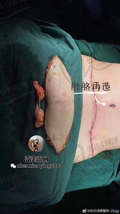 张航和李献和腹壁整形收费对比：谁更划算？