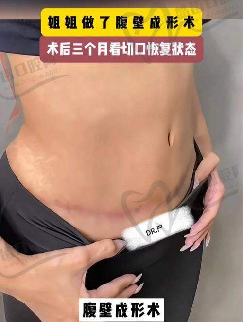 成都现代张航医生腹壁整形技术绝了，疑惑他和李献和比性价比谁更高？