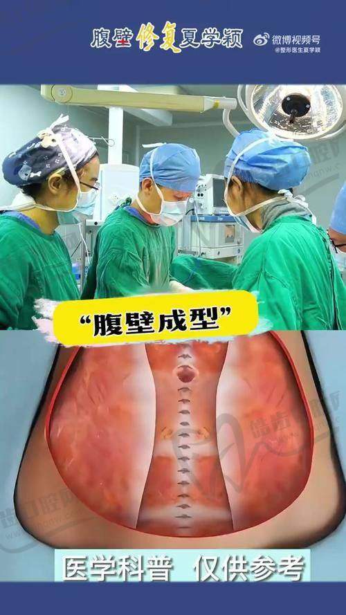 适合选择张航医生腹壁整形的典型人群