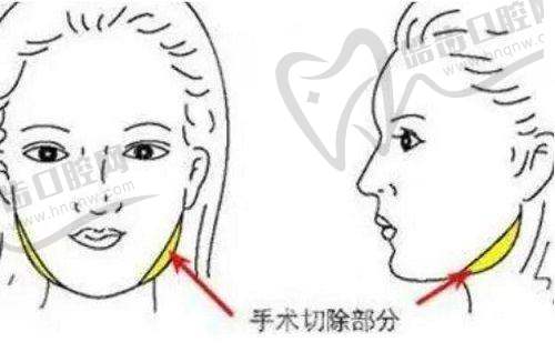 瑞士五点提升针是什么原理之适合哪些人群